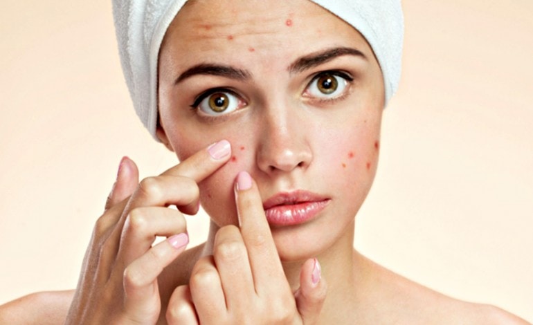 Overcoming Insecurities: Acne